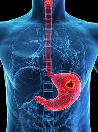 Stomach Cancer Surgical Treatment at SCMSC