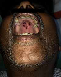 Image result for Tertiary Syphilis