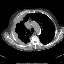 Right chest pain developed in july 2013, but no abnormality was detected on a chest computed tomography (ct) performed in september 2013, . Mesothelioma Radiology Case Radiopaedia Org