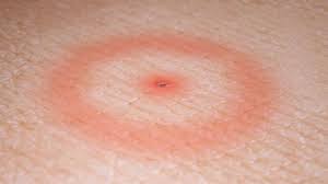 Image result for infected tick bite