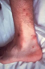 Dunkelbraune flecken mit verstreuten blassen spots werden manchmal mit „regentropfen auf einer staubigen straße umschrieben. Akute Infektiose Arthritis Erkrankungen Des Rheumatischen Formenkreises Und Des Bewegungsapparats Msd Manual Profi Ausgabe