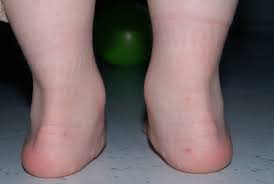 Suivant l'activité exercée les pressions sur le pied peuvent être différente. Efficacite Semelles Orthopediques 1 Forum Cheval