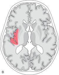 The clinical syndrome is often characterized by the rapid onset of fever, headache, seizures, focal neurologic signs, and impaired consciousness  1 . Herpes Simplex Encephalitis Radiology Key