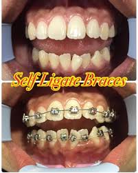 Harga braces gigi dan kos pemasangan pendakap gigi ottoman. Klinik Pergigian Dr Smile Taman Melawati Dentist In Taman Melawati