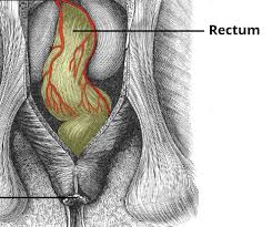 Image result for Ischiorectal Abscess