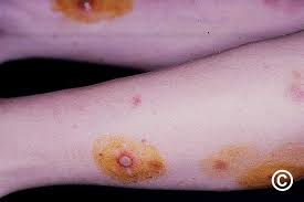 Image result for Pyoderma Gangrenosum