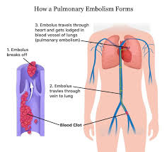 Pulmonary Embolism Pe Causes Of A Blood Clot In The Lung