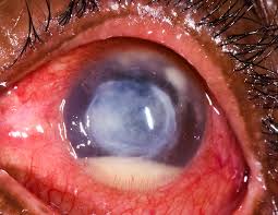 Treatment of noninfectious keratitis varies depending on the severity. Community Eye Health Journal Emergency Management Microbial Keratitis