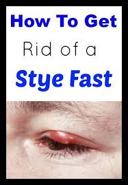 How To Treat A Stye How To Healing Treating A Stye Skin Tags Home Remedies Stye Treatment