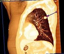 Bronchialkarzinom Wikipedia