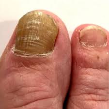 Image result for Onycholysis feet