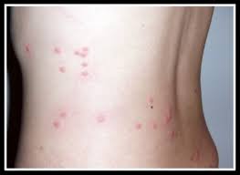 Image result for flea bite