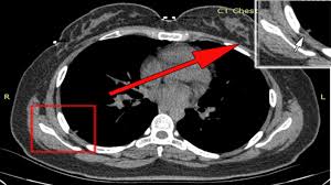 Thoracic endometriosis is defined as the presence of endometrial tissue in or around the thoracic a ct scan or mri are also highly useful imaging tests that an endometriosis specialist may advise. Thoracic Endometriosis With Catamenial Hemoptysis And Hemothorax Long Term Follow Up After Gnrh A Treatment Journal Of Thoracic Oncology