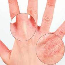 How To Treat Dry Hands Dry Skin Remedies Aromatherapy Skin Care Health And Beauty Tips