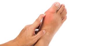 Image result for gout symptoms toe