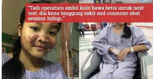 Penyakit lupus adalah penyakit autoimun kronis. Gadis 14 Tahun Derita Sle Keadaan Makin Kritikal Tanggung Sakit Terpaksa Makan Ubat Seumur Hidup