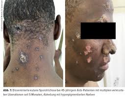 Von Lepra bis Leishmaniose - Dermatologie - Universimed - Knowledge that  matters