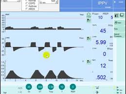 Continuous Mandatory Ventilation Cmv Volume Control Cmv Youtube