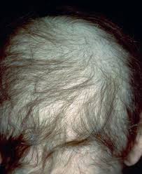 Questo tipo di alopecia manifesta perdita capillare in tutte le aree del cuoio capelluto. Alopecia Diffusa Haarverzorging Haaruitval Haarproblemen Haarziekten Haarstichting Nl