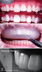 I wanted to make it my own so i covered it will contact paper. Https Meridian Allenpress Com Operative Dentistry Article Pdf 45 3 229 2488120 1559 2863 45 3 229a Pdf