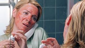 Un coup de soleil ça se paie des années plus tard ( 20 ans mini) ça peut dégénérer en mélanome. Comment Soulager Un Coup De Soleil