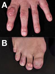 Image result for gout symptoms toe