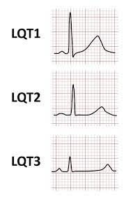 Qt Syndrom Wikiwand