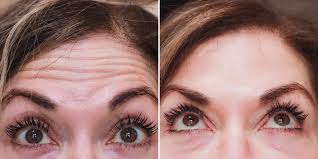 Before (left) and after (right) photos after having botox and fillers at l'atelier aesthetics in harley street, london. What You Need To Know About Getting Botox Over 40 The Right Way