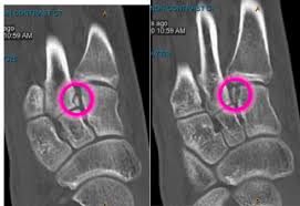 It is often confused with a sprain because of the similar causes and symptoms. 3 Case Of The Week Unstable Lisfranc Fracture Successfully Treated Non Operatively