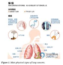 The identification of eight physical signs associated with death within 3 days for patients with advanced forms of cancer could help with clinical decision making and patient care. Medication Characteristics And Regularities Of Tcm Therapy For Lung Cancer Based On Data Mining Technology