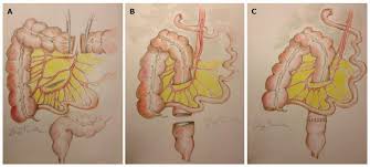 Anastomose colique, anastomosis colon, colonic anastomosis. Retroileal Trans Mesenteric Colorectal Anastomosis