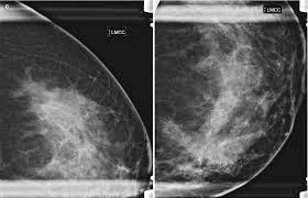 Some breast cancers grow so quickly that they appear within months of a normal (negative) screening mammogram. Diagnosis And Staging Of Breast Cancer When And How To Use Mammography Tomosynthesis Ultrasound Contrast Enhanced Mammography And Magnetic Resonance Imaging Springerlink