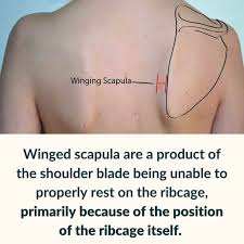 Image result for Winged Scapula