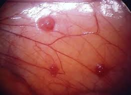 Może być umiejscowiona na jajowodzie, jajnikach, otrzewnej, jelitach. Rozpoznanie Objawow Jest Kluczem Do Diagnozowania Endometriozy Artykuly Medycyna Rodzinna Medycyna Praktyczna Dla Lekarzy