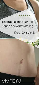 Rektusdiastase Operation Das Ergebnis Nach 4 Monaten Vivabini Rektusdiastase Bauchdeckenstraffung Bauch Weg