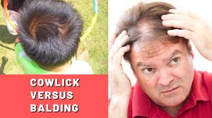 Browse our hair swirls images, graphics, and designs from +79.322 free vectors graphics. Cowlick Vs Balding An Early Sign Of Hair Loss Hairguard