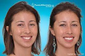 It really depends what you mean by 'naturally'. Correcting Long Or Large Looking Front Teeth