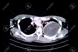 Icu patients cannot sit up and the effusion layers posteriorly. Ct Scan Of The Chest Of A Patient With Large Loculated Pleural Effusion In His Left Thoracic Cavity Stock Photo Picture And Royalty Free Image Image 113899228