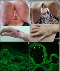 Image result for Pemphigoid