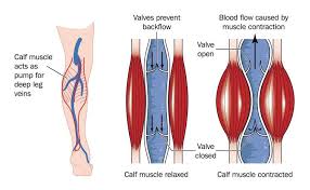 May Thurner Syndrome The Role Of Endovascular Intervention With Review Of Published Treatment And Follow Up Strat Venous Insufficiency Leg Cramps Calf Muscles