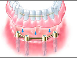 Bu kelimeleri ezberleyerek derslerinize katkı sağlayabilirsiniz… Implantologie Praxis Fur Zahnmedizin Dr Volker Baumeister