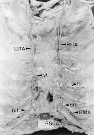 In human anatomy, the internal thoracic artery (ita), previously commonly known as the internal mammary artery (a name still common among surgeons), is an artery that supplies the anterior chest wall and the breasts. Surgical Anatomy Of The Internal Thoracic Artery The Annals Of Thoracic Surgery