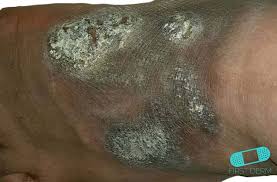 Image result for Neurodermatitis