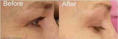 Revive Anti Aging Light Therapy Handheld System Product Review Beauty Realty Your Home For The Best Beauty Products