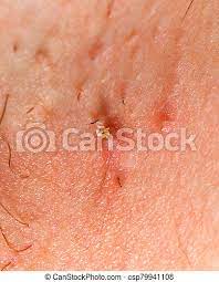 The good news is that they aren't too serious and won't cause any problems as long as you. Ingrown Hair After Shaving Close Up Photo Of Ingrown Hair After Shaving Canstock