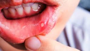 Diarrhea was the norm while i was sick, though diarrhea is not exclusive to covid. Could Covid 19 Cause Oral Ulcers Top Rated Cosmetic General Dentist In Mesa Az 85203 Eastport Dental