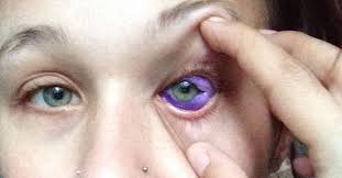 Also in 2017, paul freund, md, and mark greve, md, from the university of alberta in canada reported on a tragic case. Sclera Tattoo Causes Model S Severe Eye Infection Possible Blindness Teen Vogue