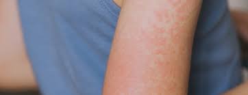 Image result for measles