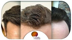 Il prezzo finale di una protesi standard** da uomo è 230 euro · * lace/rete sottile (swiss) o leggermente più spessa (french); Protesi Archivi Private And Friends Centro Infoltimento Capelli