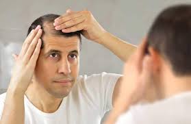 Alopecia Por Estres Sintomas Causas Y Como Solucionarlo